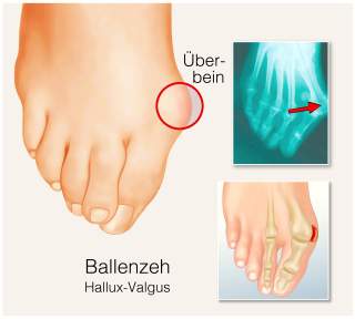 Illustration eines an Hallux Valgus erkrankten Fußes